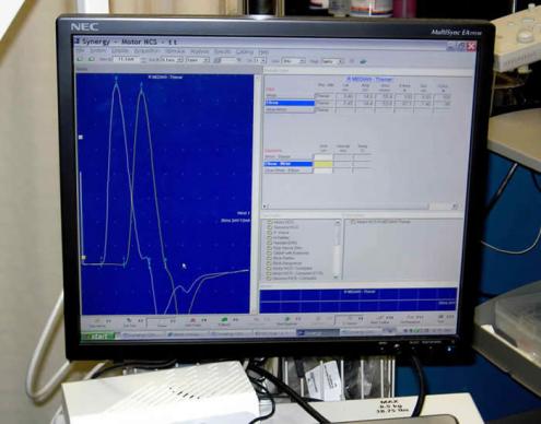 Nerve conduction study results on the EMG testing equipment