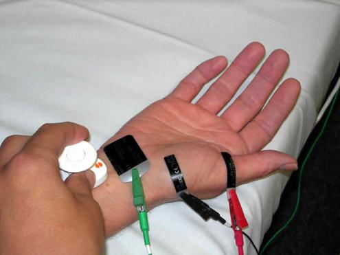 A typical nerve conduction study of the hand