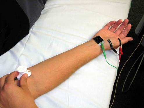 A typical nerve conduction study of the forearm