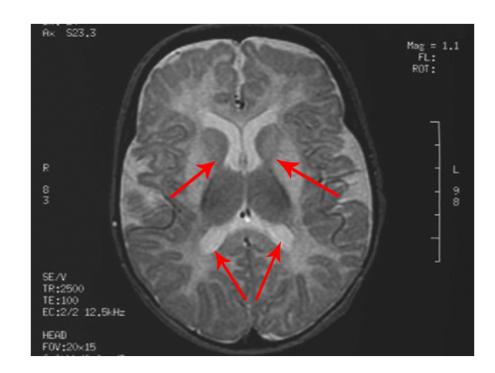 Changes in White Matter