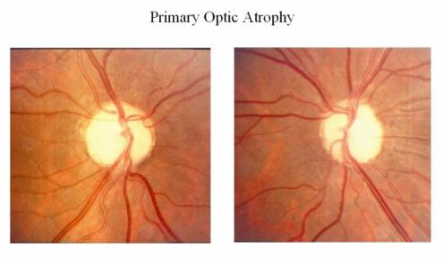 Primary Optic Atrophy
