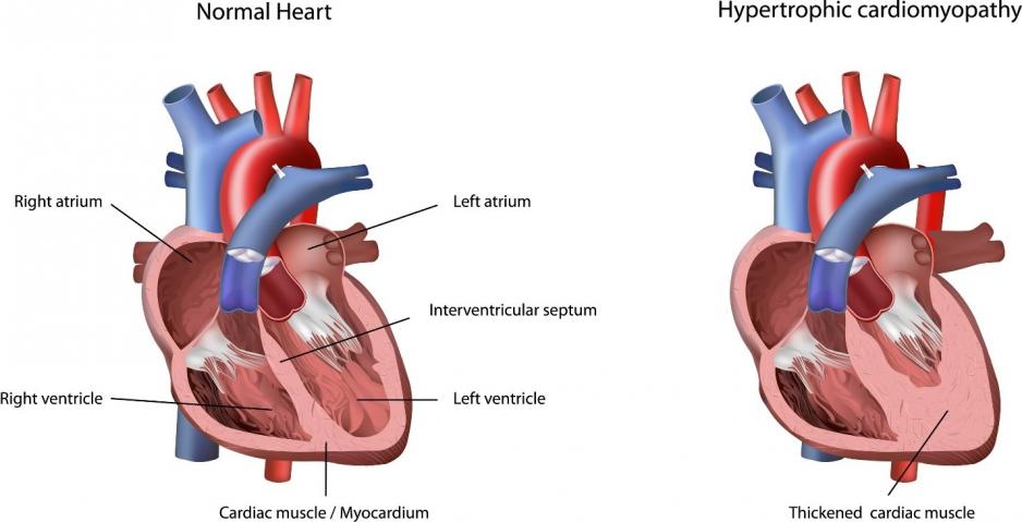 Hypertrophic cardiomyopathy