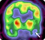 PET scan of brain.
