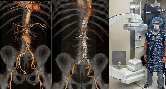 Frank Franze and the x-ray c-arm; CT of an Abdominal Aortic Aneurysm; CT of an Abdominal Aortic Aneurysm after having an Endovascular Aneurysm Repair