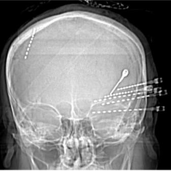 electrode inserted in skull