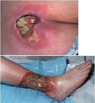 Infection | Lhsc