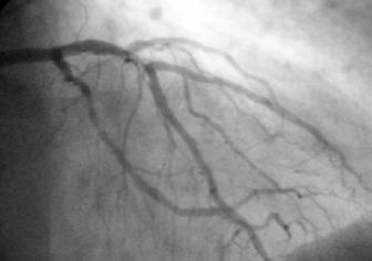 Coronary Angiogram