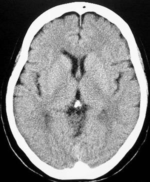 C T scan of healthy brain