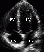 echocardiogram of the heart