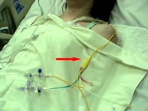 Pulmonary Artery Catheter, also called a Swan Ganz