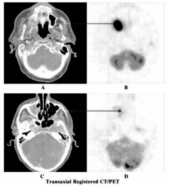 PET CT Scan