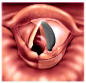 laryngeal carcinoma