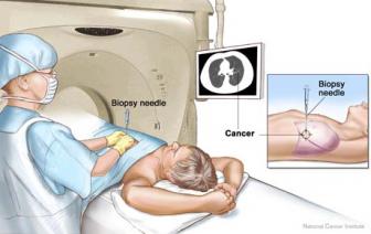 biopsy