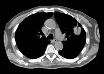 Lung Needle Biopsy